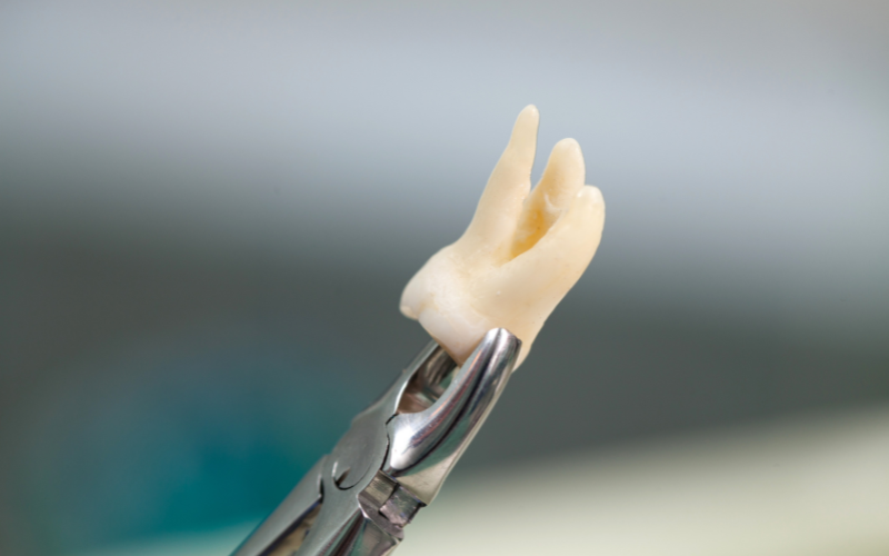 Tooth extraction at Stomatologia, Bannerghatta Road Bangalore