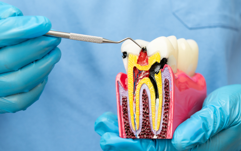 Painless root canal treatment in Bangalore