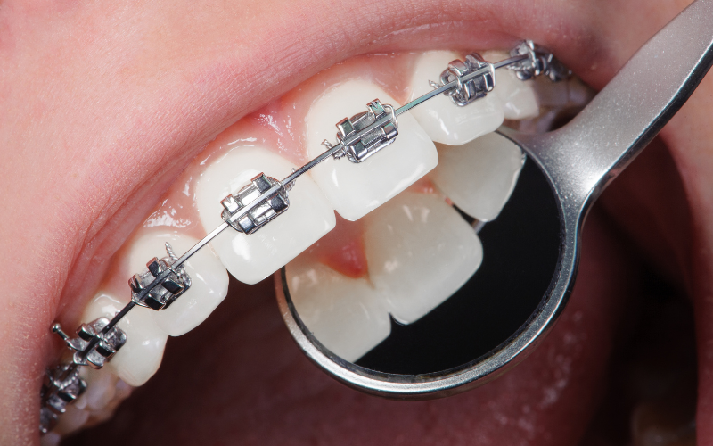 Braces and aligners orthodontic treatment in Bangalore